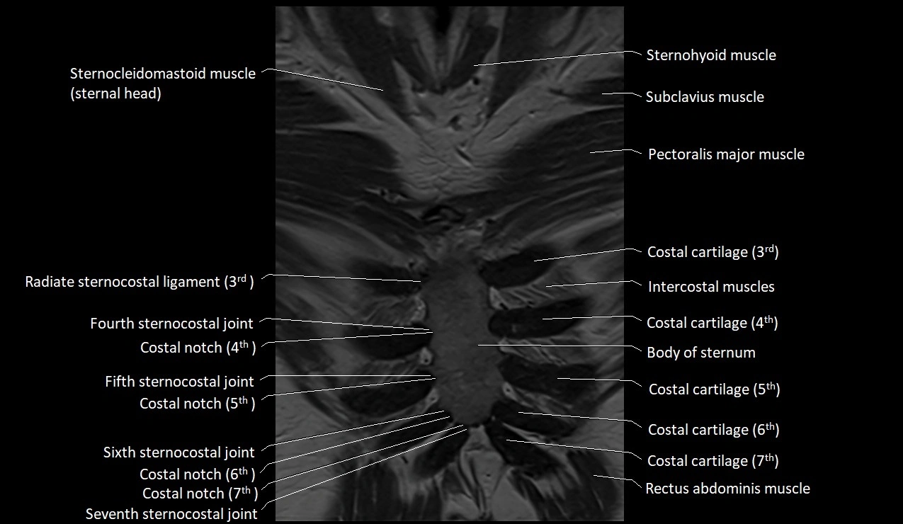 MRI sternum and sternoclavicular joint labeled coronal anatomy image 6.webp